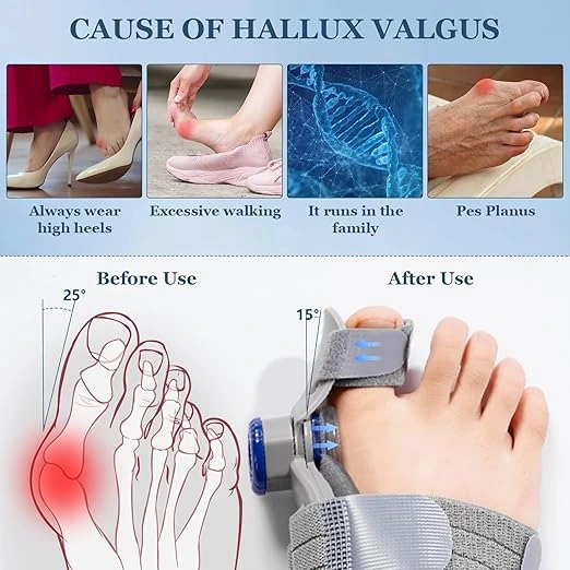 orthopedic hallux valgus corrector abu dhabi